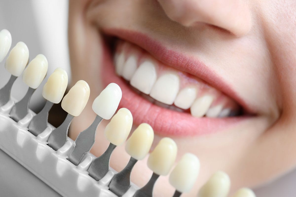 blanqueamiento dental colores