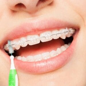 brakets ceramicos