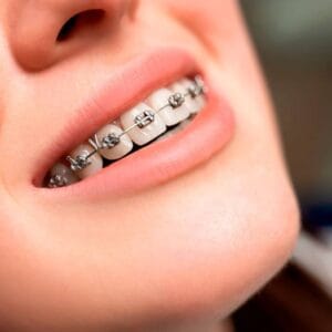 brakets metalicos