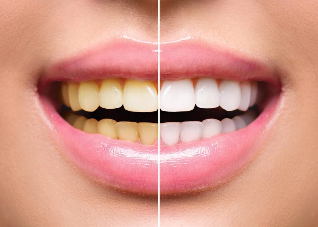 tratamiento blanqueamiento dental dentalix (1)