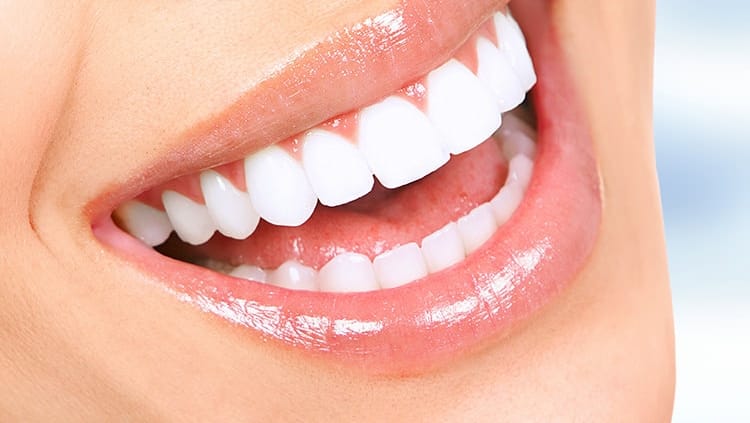 Carillas dentales en Cúcuta precio