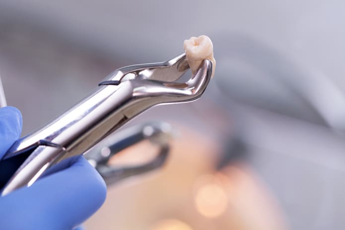 Precio de extracción dental en Cúcuta