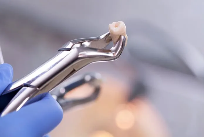 Precio de extracción dental en Cúcuta