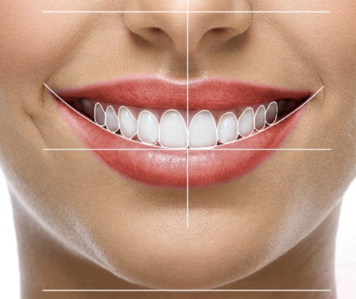 Diseño de sonrisa precio en Cúcuta Colombia