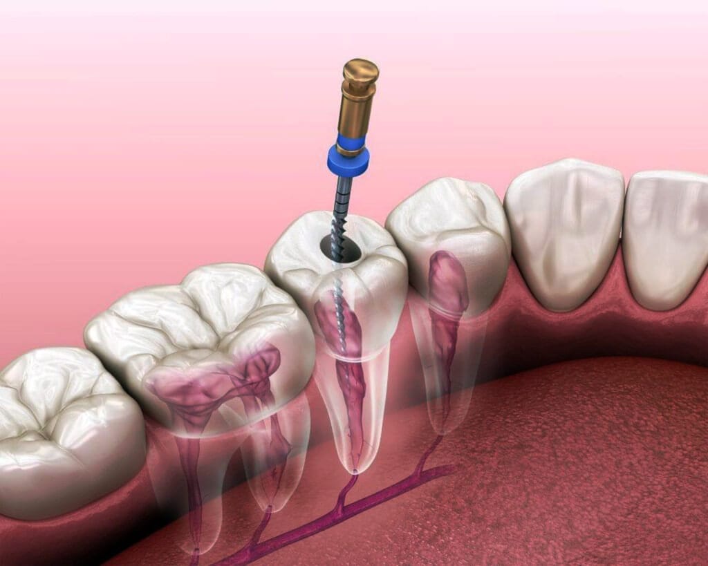 Precio de endodoncia en Cúcuta