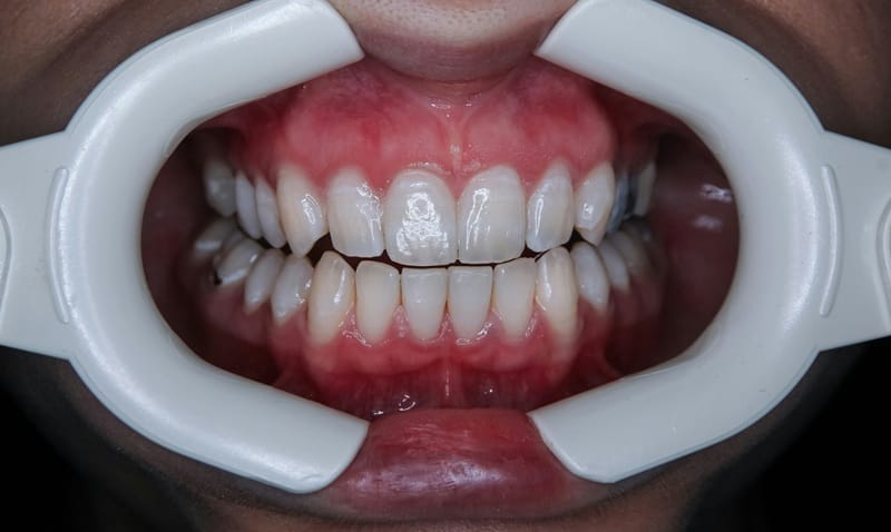 Blanqueamiento dental seguro en Cúcuta