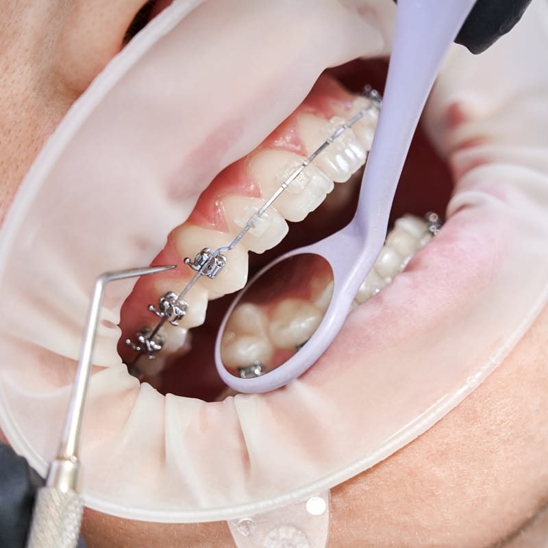 Brackets en Cúcuta precio completo