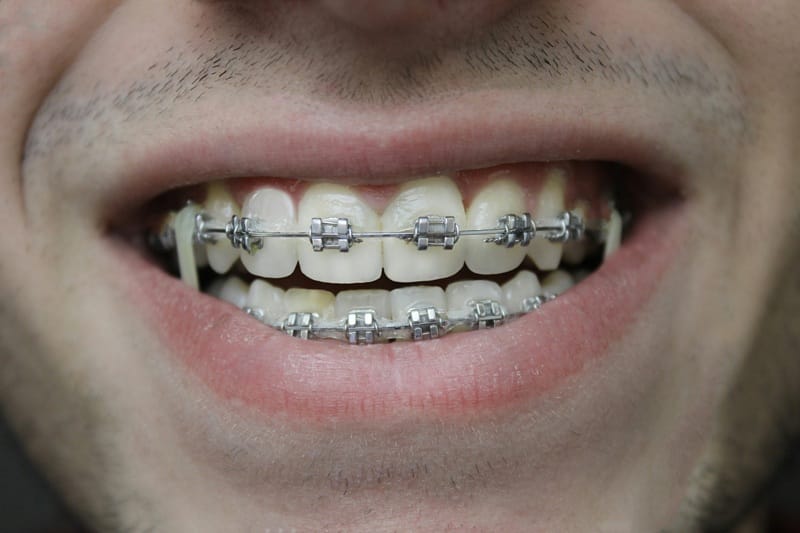 Brackets en Cúcuta precio y financiación