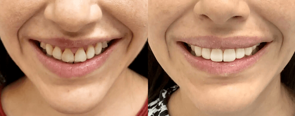 Diseño de sonrisa antes y después Cúcuta