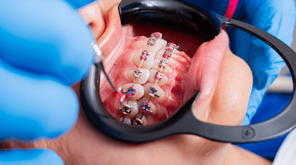 Qué revisar antes de ponerse brackets