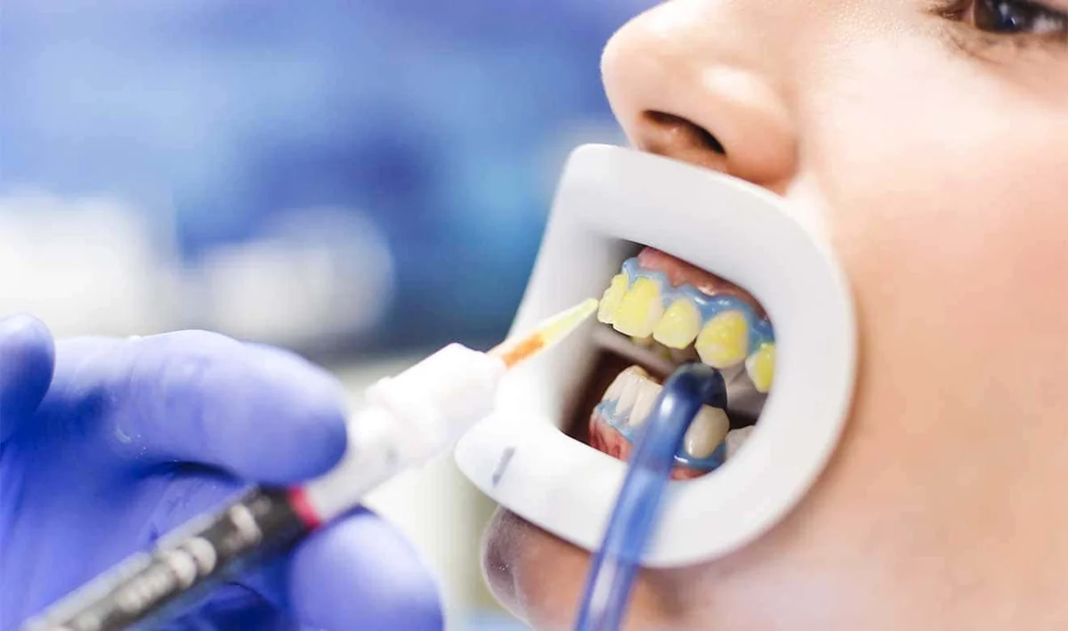 Blanqueamiento dental profesional en Cúcuta - aclaramiento dental con resultados visibles desde la primera sesión