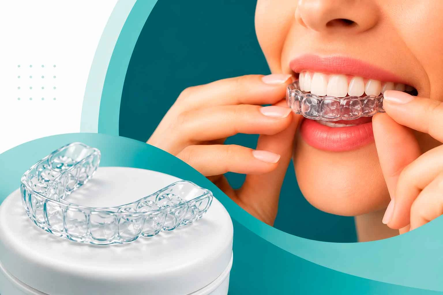 Placas de bruxismo en Cúcuta - protección contra el desgaste dental