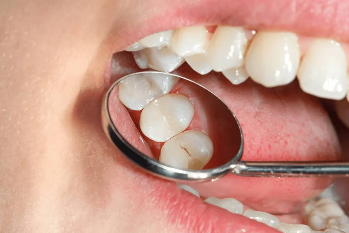 Calzas dentales en Cúcuta - restauración estética en resina de alta calidad para tratar caries en Dentalix