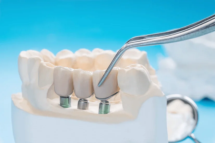 Implantes dentales en Cúcuta - implante de titanio ZimVie certificado INVIMA con alta osteointegración