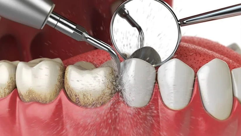 Limpieza dental en Cúcuta - profilaxis profesional con ultrasonido y pulido en Dentalix