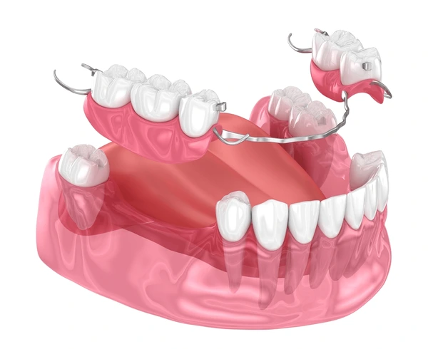 Prótesis dentales en Cúcuta - removibles y sobre implantes